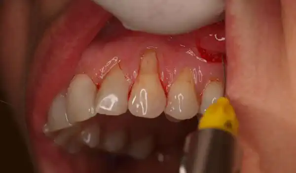 Image for case Multiple gingival recessions treated with the modified coronally advanced flap in conjunction with mucoderm®