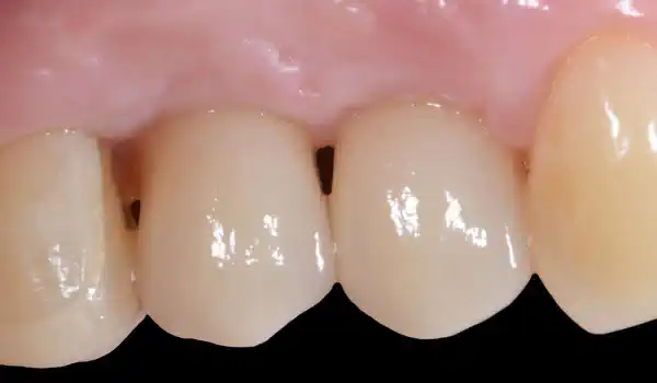 Image for case Immediate implantation with maxresorb® inject – Dr. D. Jelušić