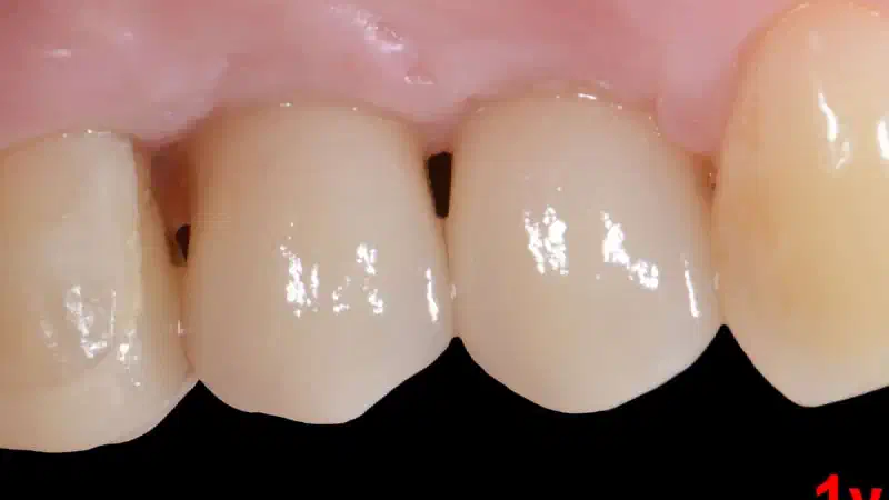 Immediate implantation with maxresorb® inject – Dr. D. Jelušić