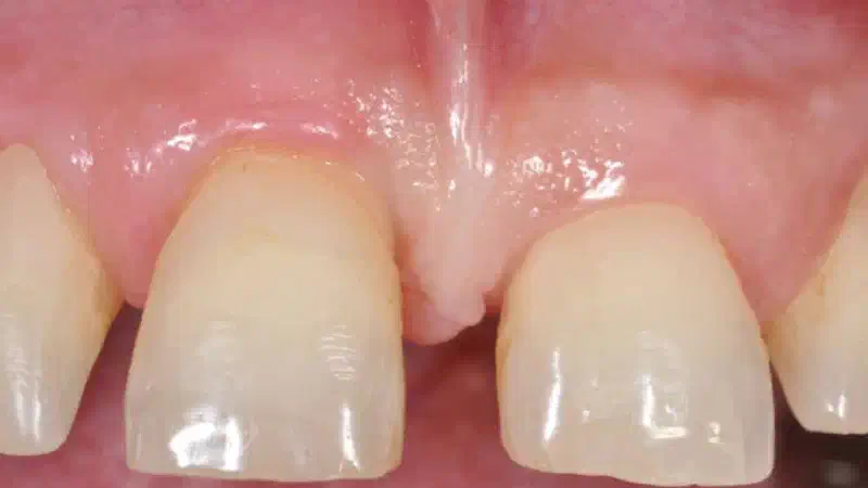 Regeneration of an intrabony defect using collpotect® membrane & cerabone®
