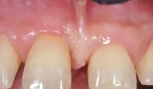 Image for case Regeneration of an intrabony defect using collpotect® membrane & cerabone®