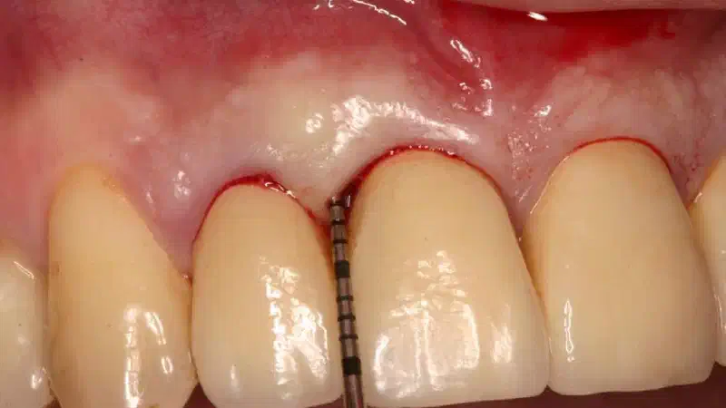 Non-contained intrabony defect treated with the simplified papilla preservation flap in conjunction with Straumann® Emdogain® and a particulate bone grafting material