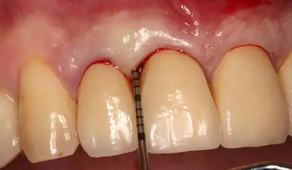 Image for case Non-contained intrabony defect treated with the simplified papilla preservation flap in conjunction with Straumann® Emdogain® and a particulate bone grafting material