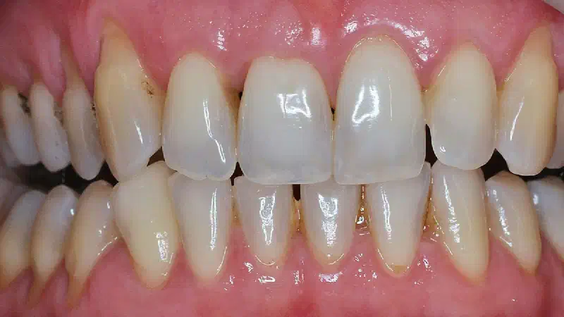 Multiple gingival recessions treated with the modified coronally advanced tunnel in conjunction with mucoderm® and Straumann® Emdogain®