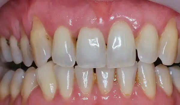 Image for case Multiple gingival recessions treated with the modified coronally advanced tunnel in conjunction with mucoderm® and Straumann® Emdogain®