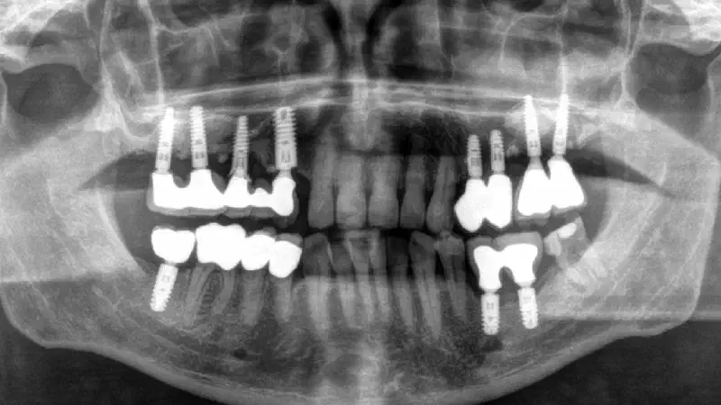 Periimplatitis treatment with maxgraft® bonering