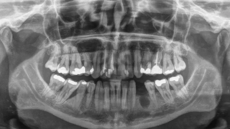 Augmentation of buccal and lingual bone lamella with maxgraft® bonering