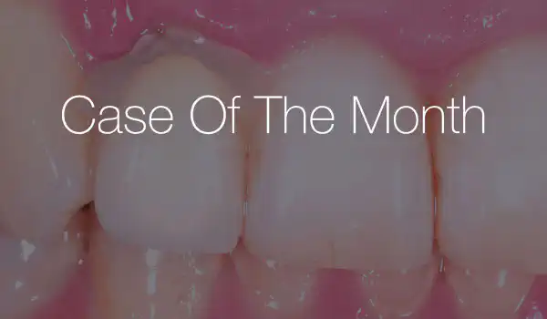 Image for case Immediate implant placement in the maxilla with contour GBR