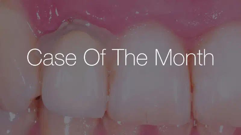 Immediate implant placement in the maxilla with contour GBR