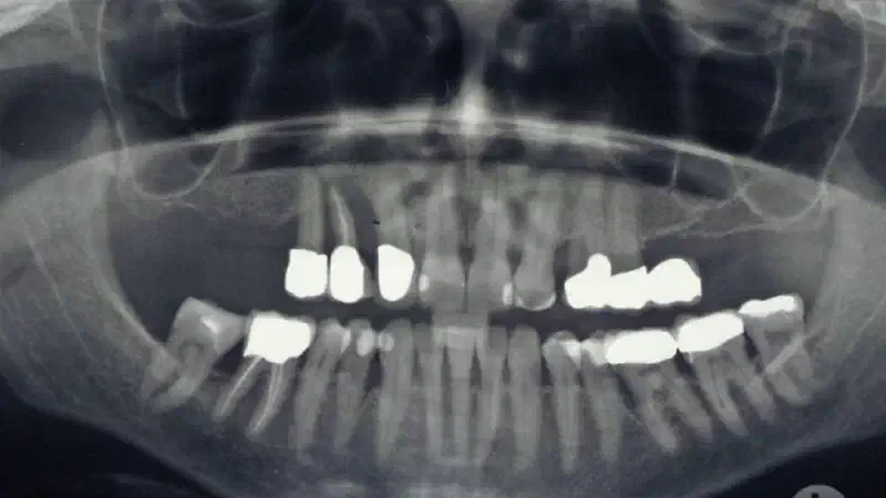 Advanced vertical augmentation in posterios maxilla with maxgraft® bonering