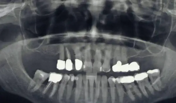 Image for case Advanced vertical augmentation in posterios maxilla with maxgraft® bonering