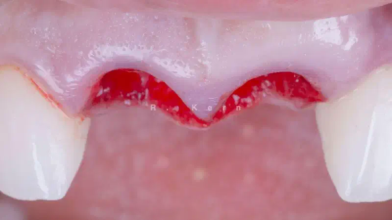Immediate implant placement and periimplant bone augmentation using cerabone®