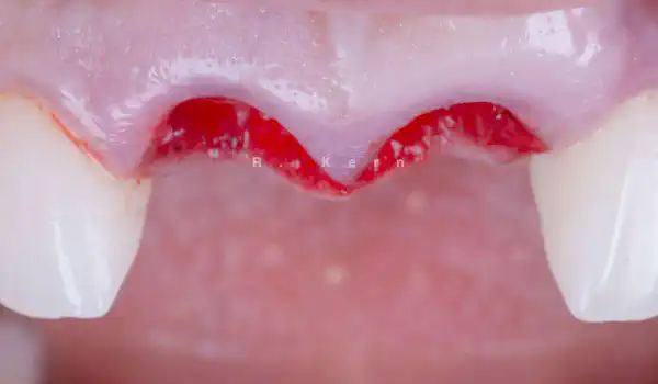 Image for case Immediate implant placement and periimplant bone augmentation using cerabone®