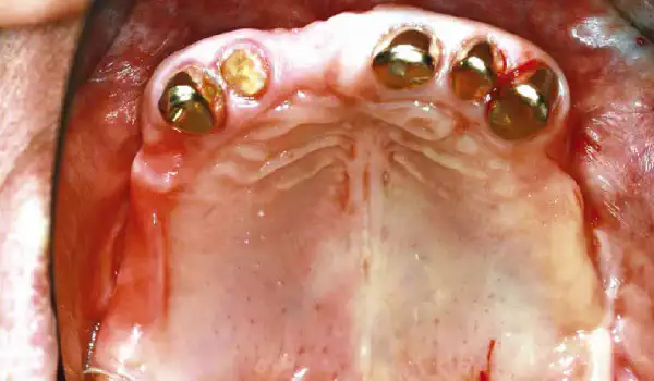 Image for case Augmentation with maxgraft® cortico – JAN KIELHORN