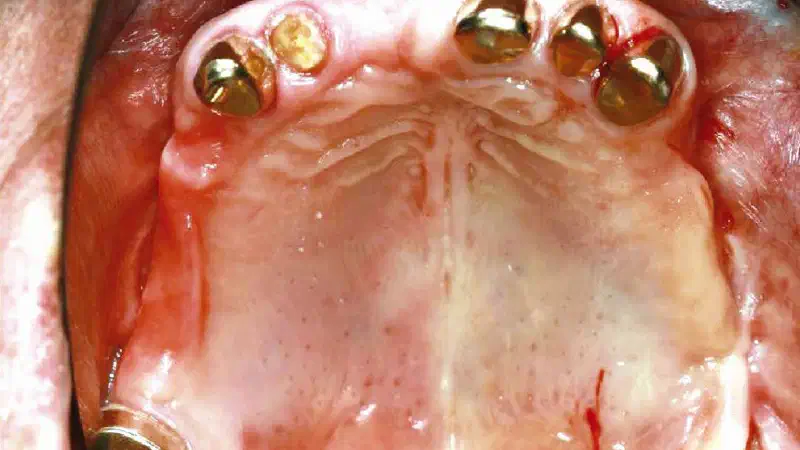 Augmentation with maxgraft® cortico – JAN KIELHORN