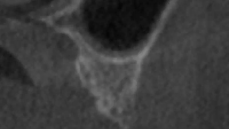 Sinus lift with simultaneous bone splitting & implantation