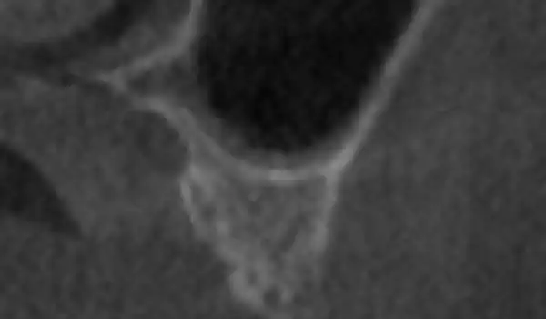 Image for case Sinus lift with simultaneous bone splitting & implantation