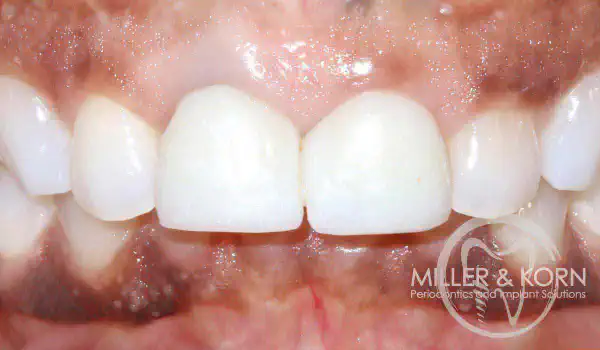 Image for case Immediate implant placement and regeneration of ridge using an allograft bone ring and Jason® membrane
