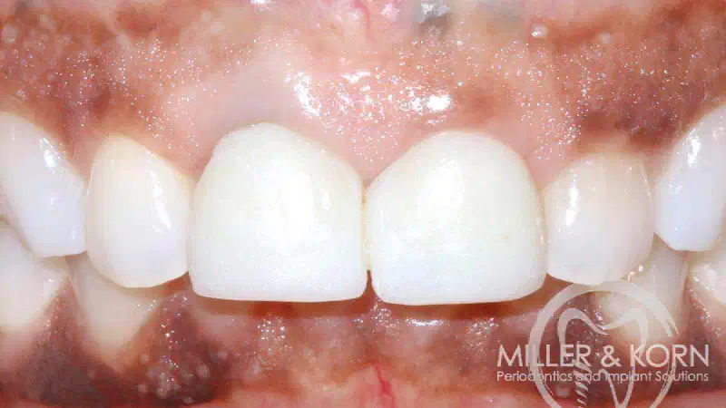 Immediate implant placement and regeneration of ridge using an allograft bone ring and Jason® membrane