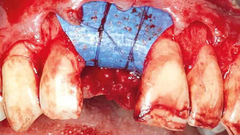 Ridge preservation using permamem®, maxgraft® granules and autologous bone