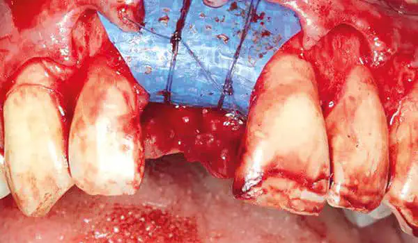 Image for case Ridge preservation using permamem®, maxgraft® granules and autologous bone