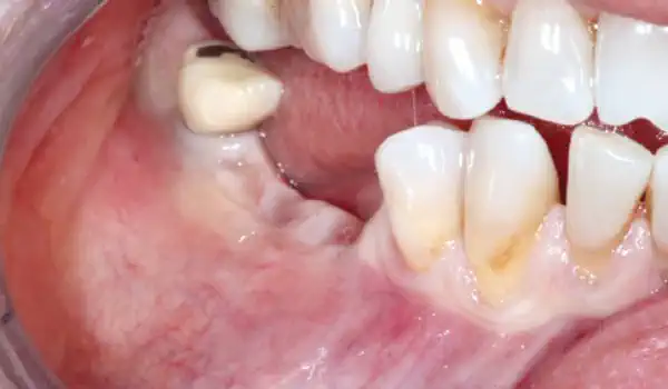 Image for case GBR with cerabone® and Jason® membrane Dentalpro