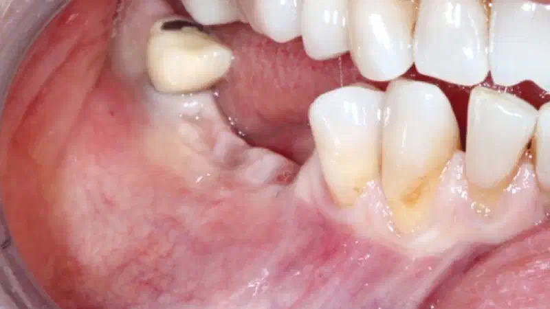 GBR with cerabone® and Jason® membrane Dentalpro