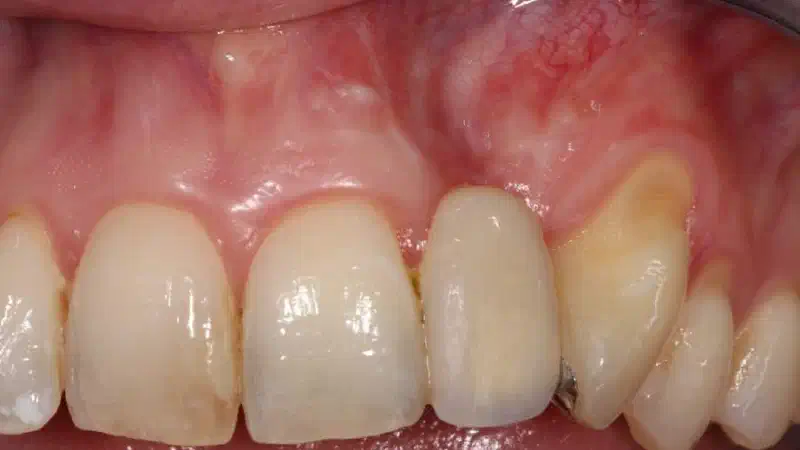 Block augmentation with maxgraft® in the maxilla