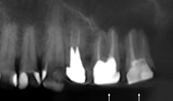 Image for case Treatment of an oroantral communication using permamem®