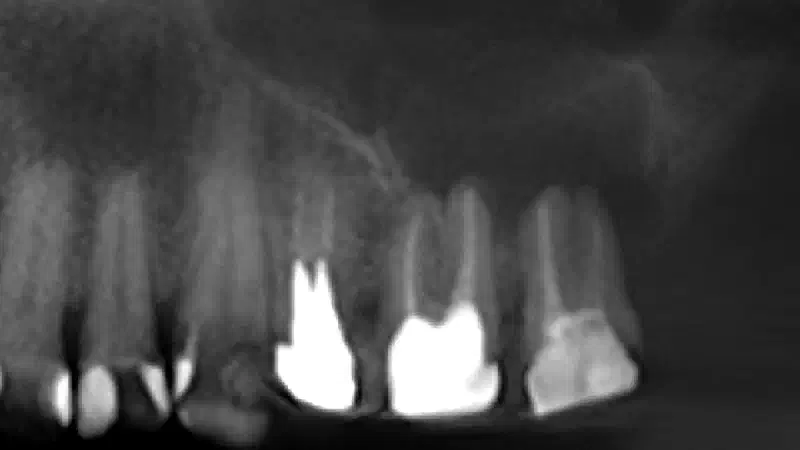 Treatment of an oroantral communication using permamem®