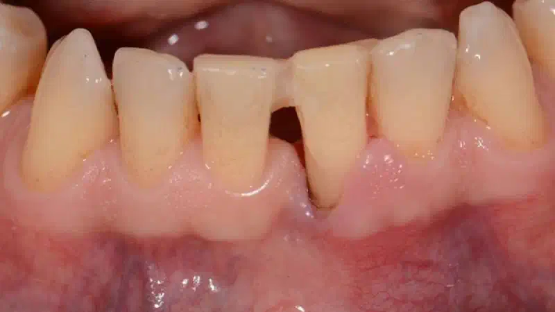 Two-wall intrabony defect treated using cerabone® and Straumann® Emdogain®