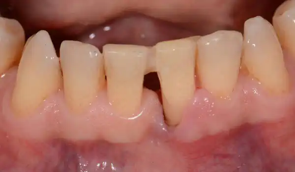 Image for case Two-wall intrabony defect treated using cerabone® and Straumann® Emdogain®