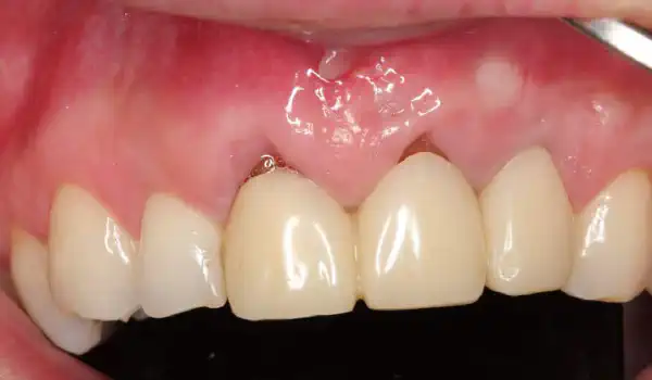 Image for case Multiple gingival recessions treated with the modified coronally advanced tunnel in conjunction with mucoderm® and Straumann® Emdogain®