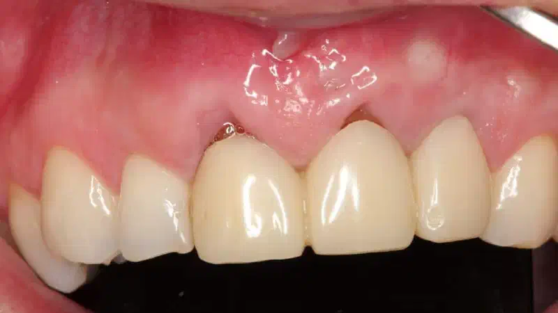 Multiple gingival recessions treated with the modified coronally advanced tunnel in conjunction with mucoderm® and Straumann® Emdogain®