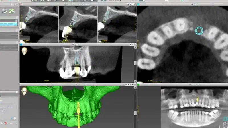Guided bone ring procedure in aesthetic zone