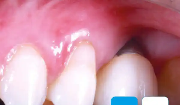 Image for case Soft tissue thickening with mucoderm®