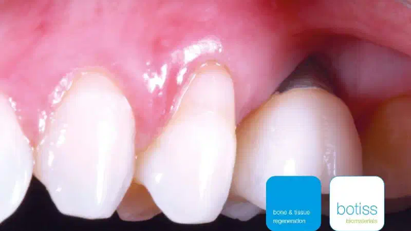 Soft tissue thickening with mucoderm®