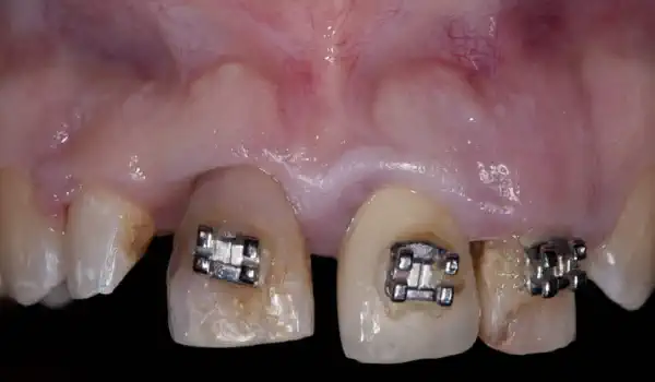 Image for case Socket preservation with collacone®