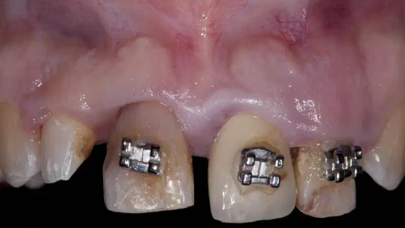 Socket preservation with collacone®