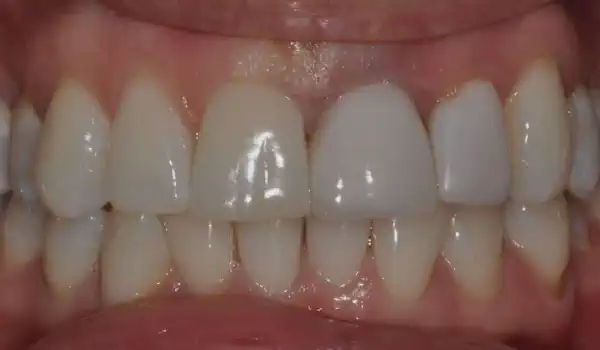 Image for case Socket preservation with cerabone® – R. A. Nader