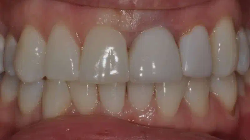 Socket preservation with cerabone® – R. A. Nader