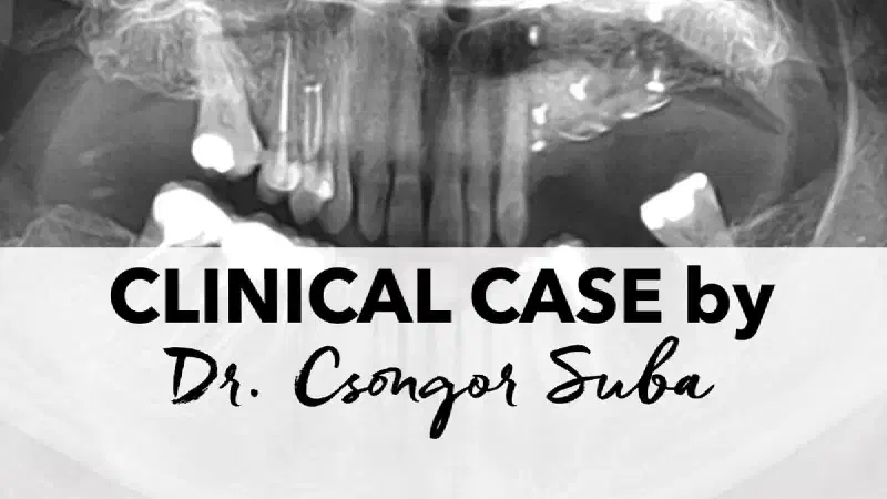 Bone- and soft tissue augmentation for implant-supported restoration of the posterior maxilla