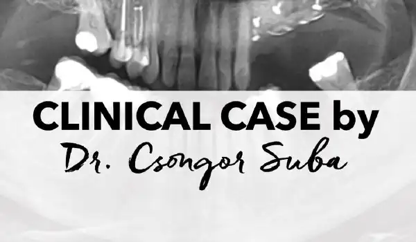 Image for case Bone- and soft tissue augmentation for implant-supported restoration of the posterior maxilla