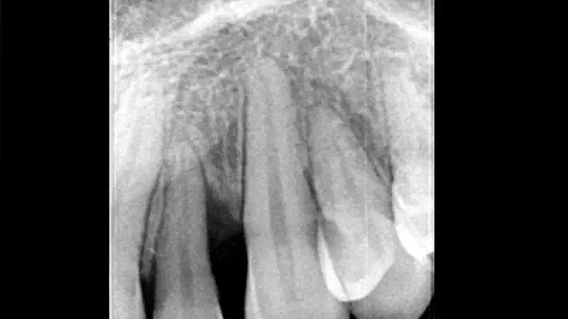 Non-contained intrabony defect treated with the modified papilla preservation flap in conjunction with cerabone® and Straumann® Emdogain®