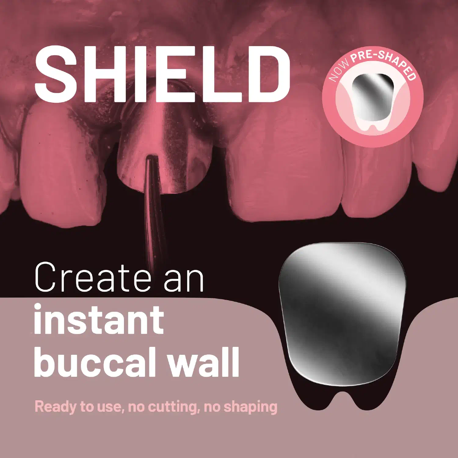 SHIELD – create an instant buccal wall