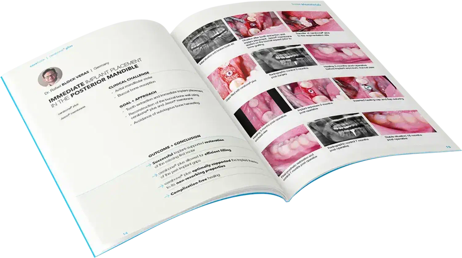 Clinical casebook cerabone® +HyA