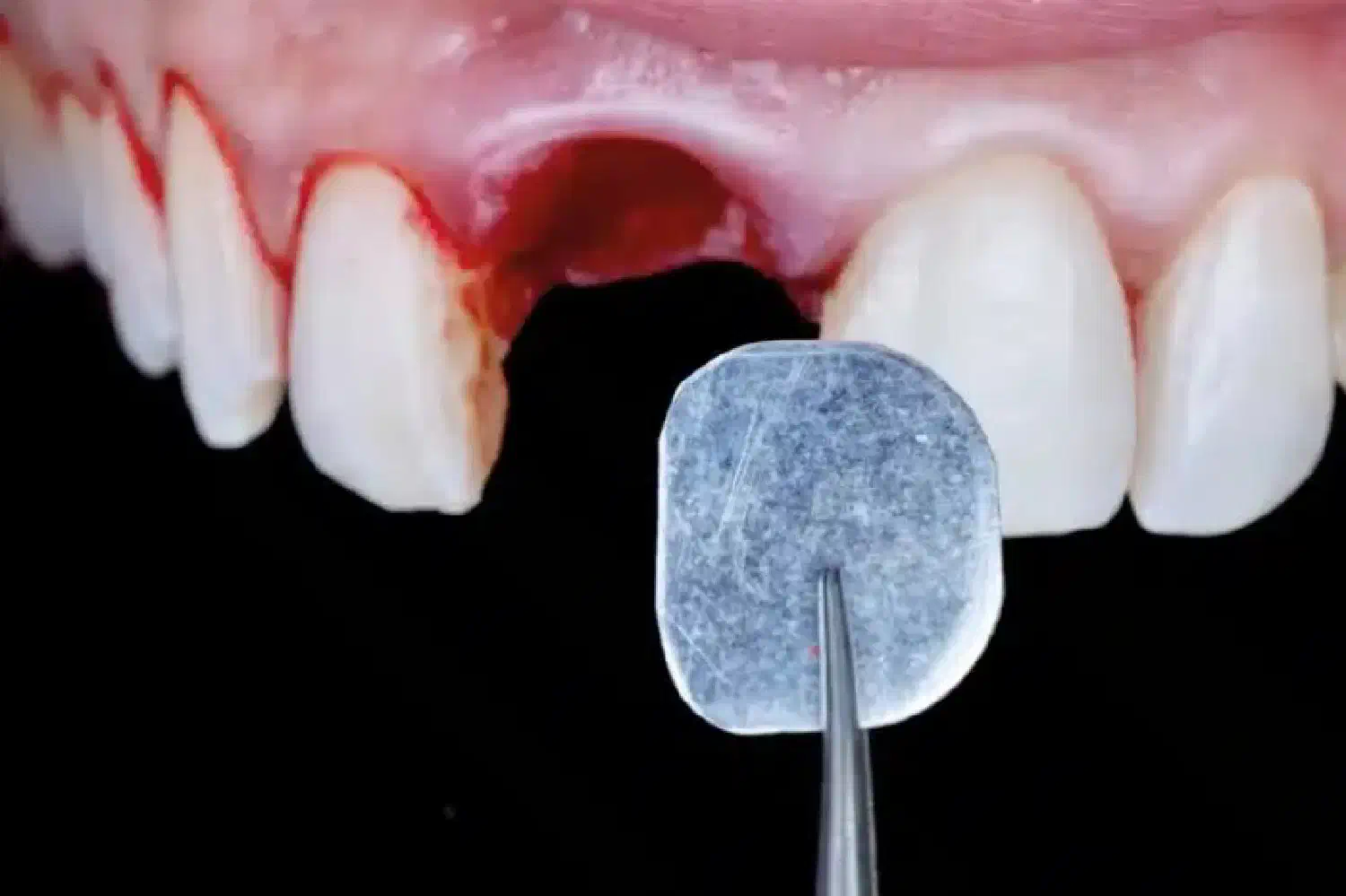 NOVAMag® SHIELD with immediate implant and temporization