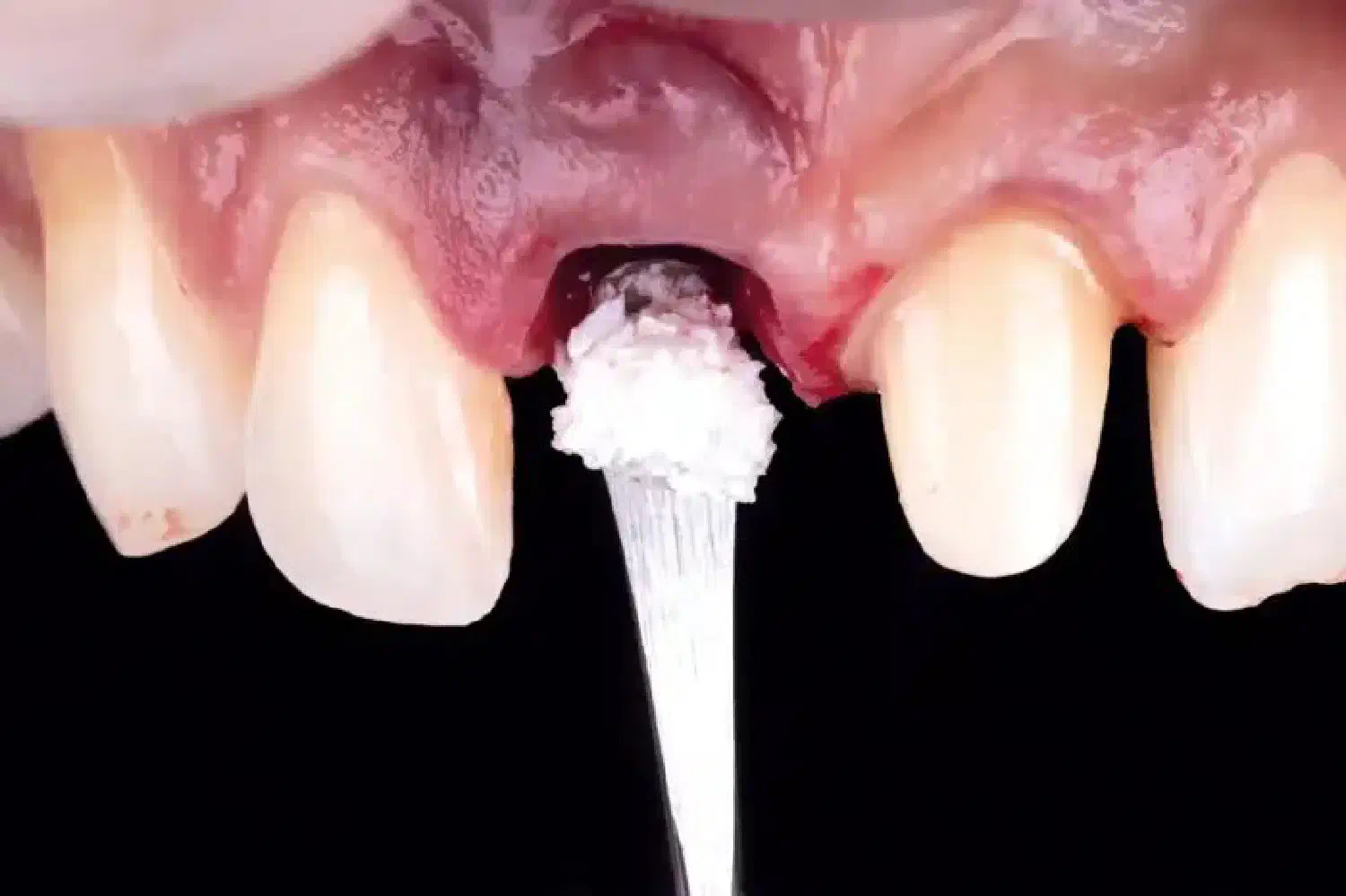 Delayed implant placement with NOVAMag® SHIELD and cerabone®