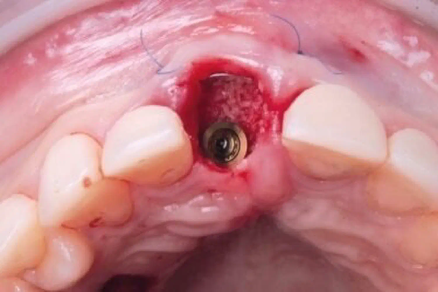 Immediate implant placement using NOVAMag® SHIELD technique
